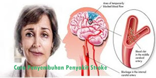 Illustration for article titled Obat Stroke Alami Ampuh